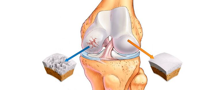 Arthrose déformante de l'articulation du genou (à gauche) et d'une articulation saine (à droite)